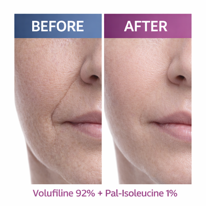 Volufiline 92% + Pal-Isoleucine 1% Advanced Plumping Formula for Hollow & Sagging Areas